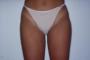 Intervento Liposculturadopo