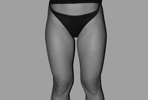 foto liposcultura fronte